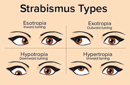 unnamed (29) Types of Strabismus diagram